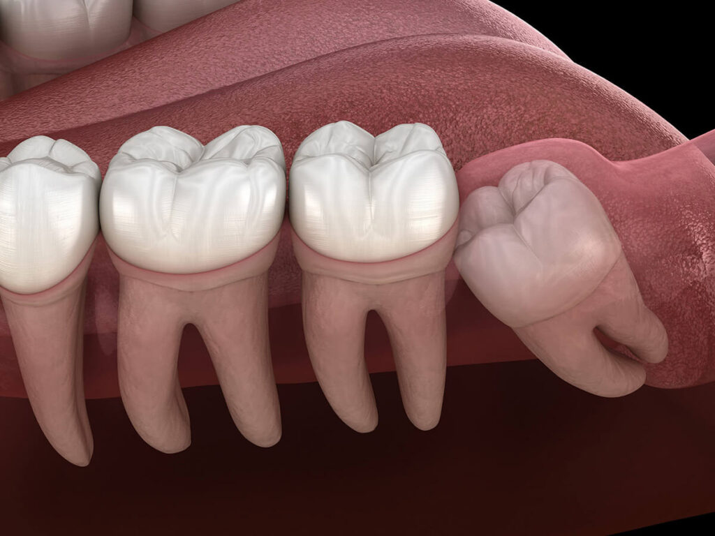 wisdom tooth removal
